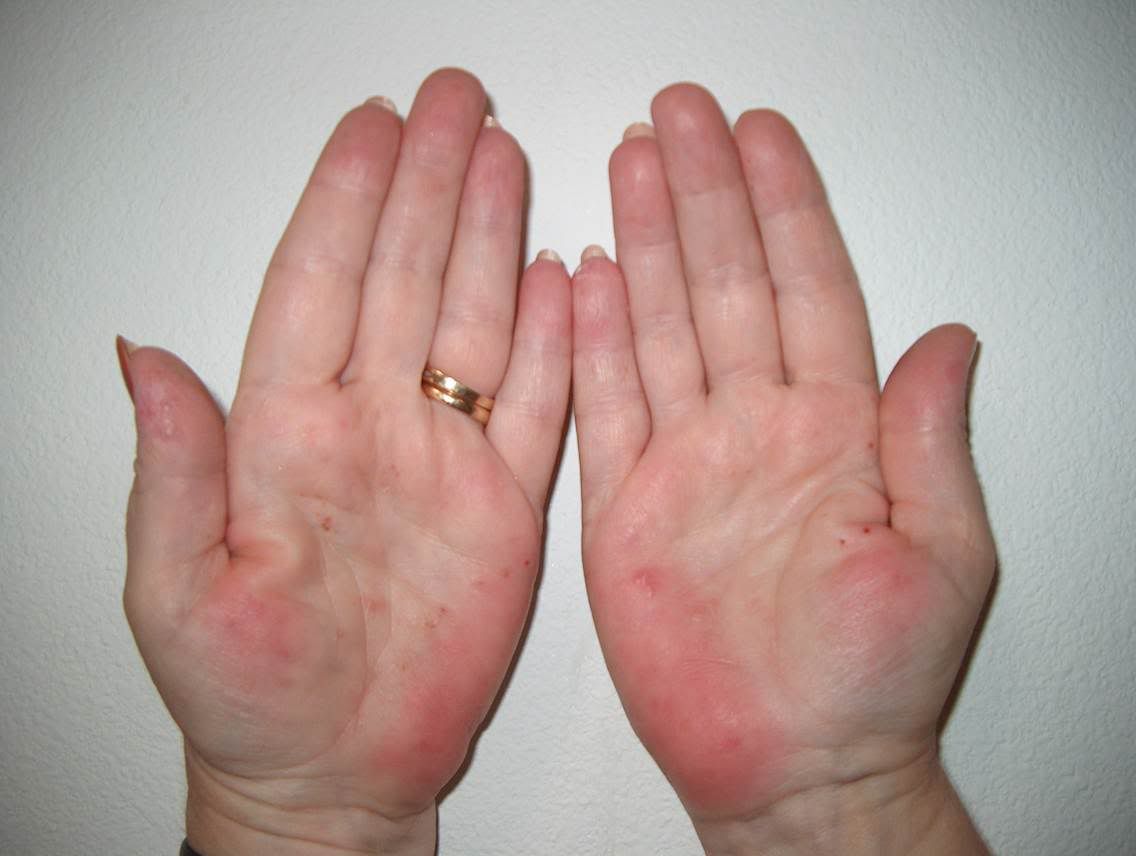 The skin on my hands and feet is peeling - NetDoctor.co.uk ...
