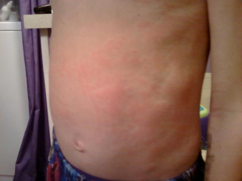 ranitidine zantac® zantac vs tums
